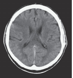 A Case Of Facial Droop