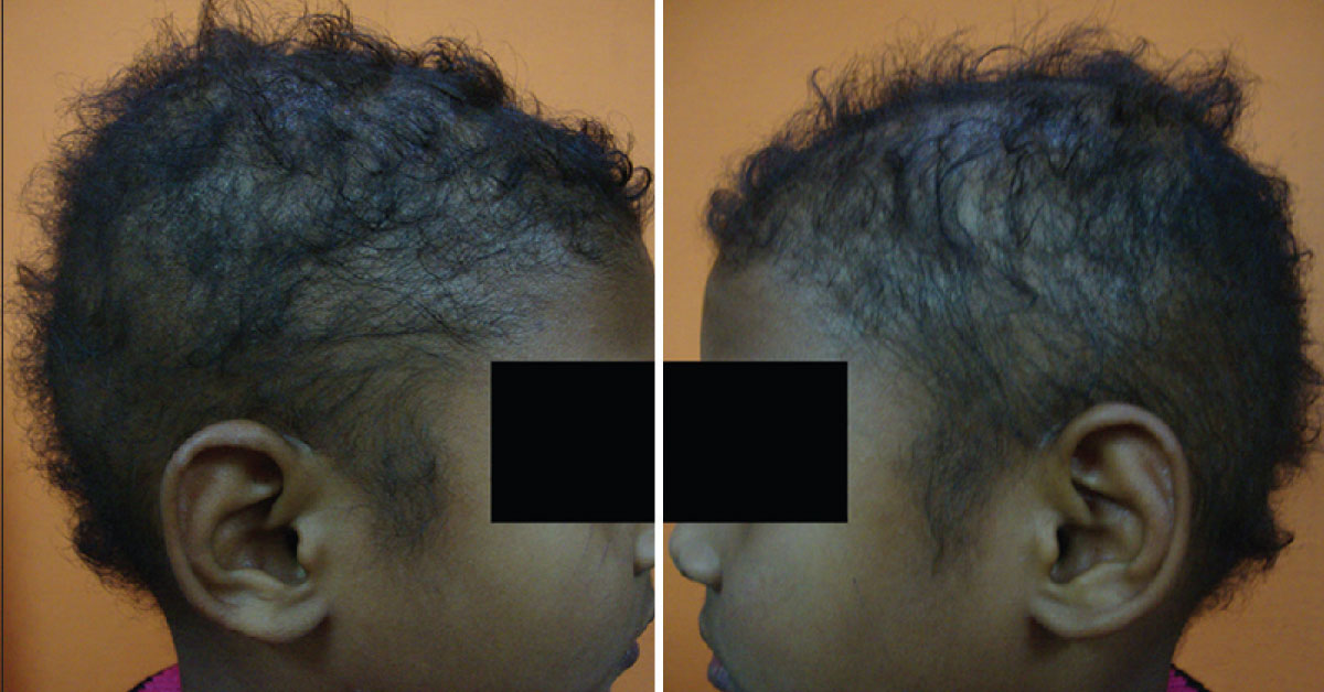Easily Pluckable Hair In A Four Year Old