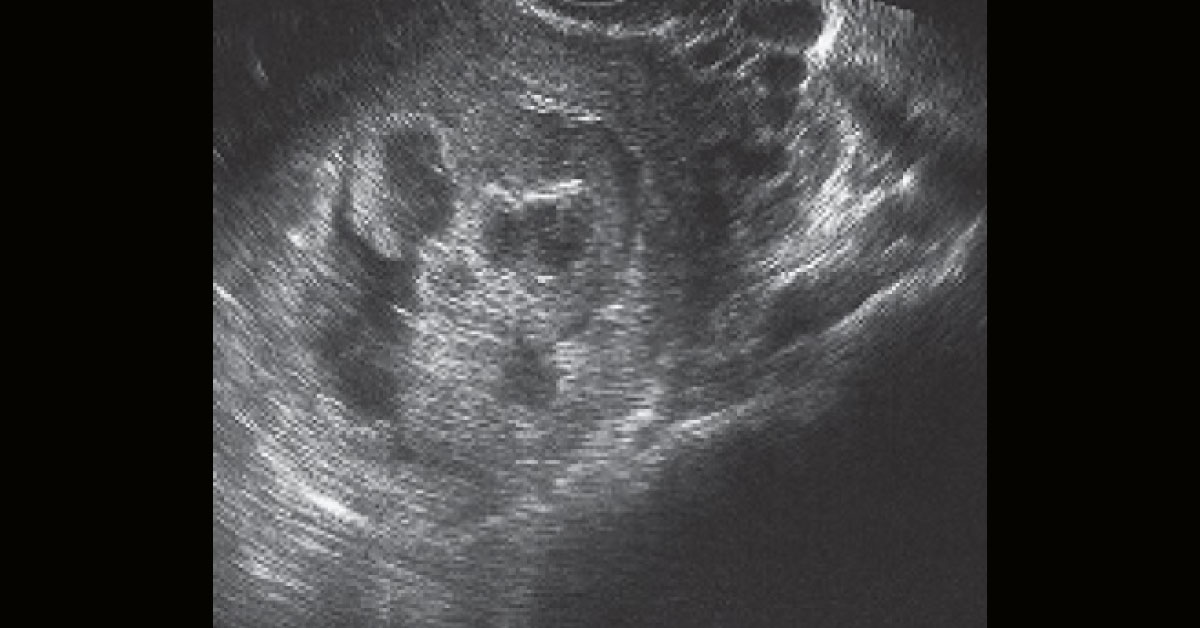 Bleeding In Early Pregnancy