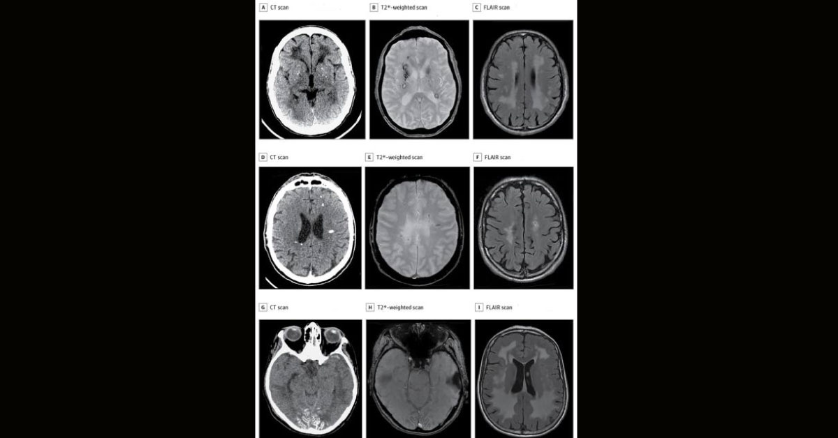35 Year Male With Late- Onset Seizure And Imaging Abnormality