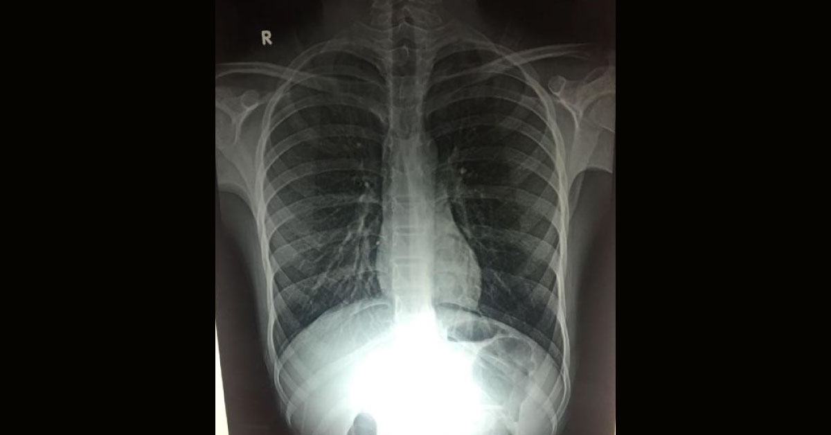Small size of Heart in X-ray chest PA view