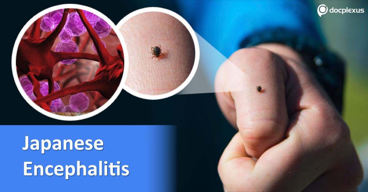 Japanese Encephalitis, An Overview