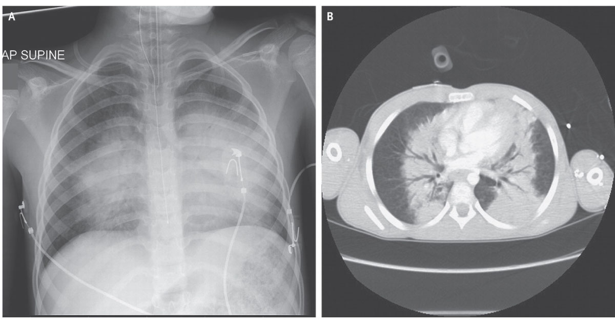 Spot The Pulmonary Condition In A Child