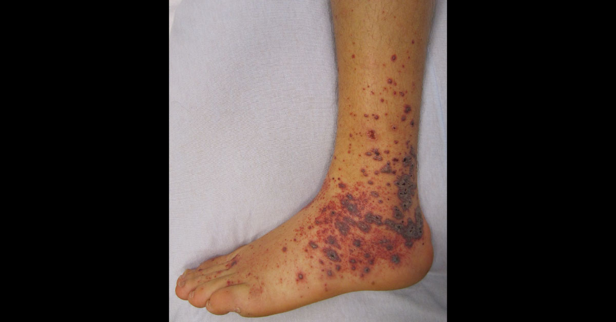 Thrombotic Thrombocytopenic Purpura Treated with Vincristine
