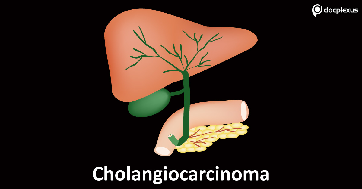 Liver Fluke Induced Bile Duct Cancer