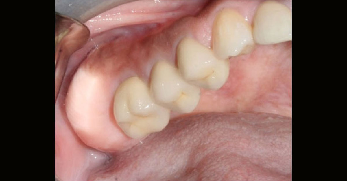 Case Of A Maxillary Tuberosity Mass