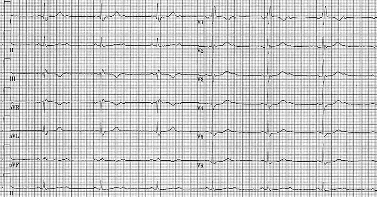 Identify The Causative Factor For Syncope