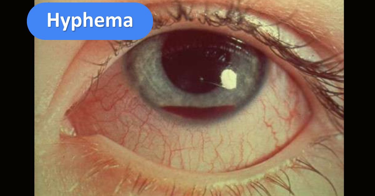 Solve This Case Of Ophthalmology