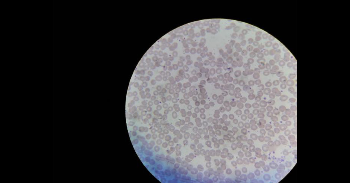 Clinical Observation Of Peripheral Smear