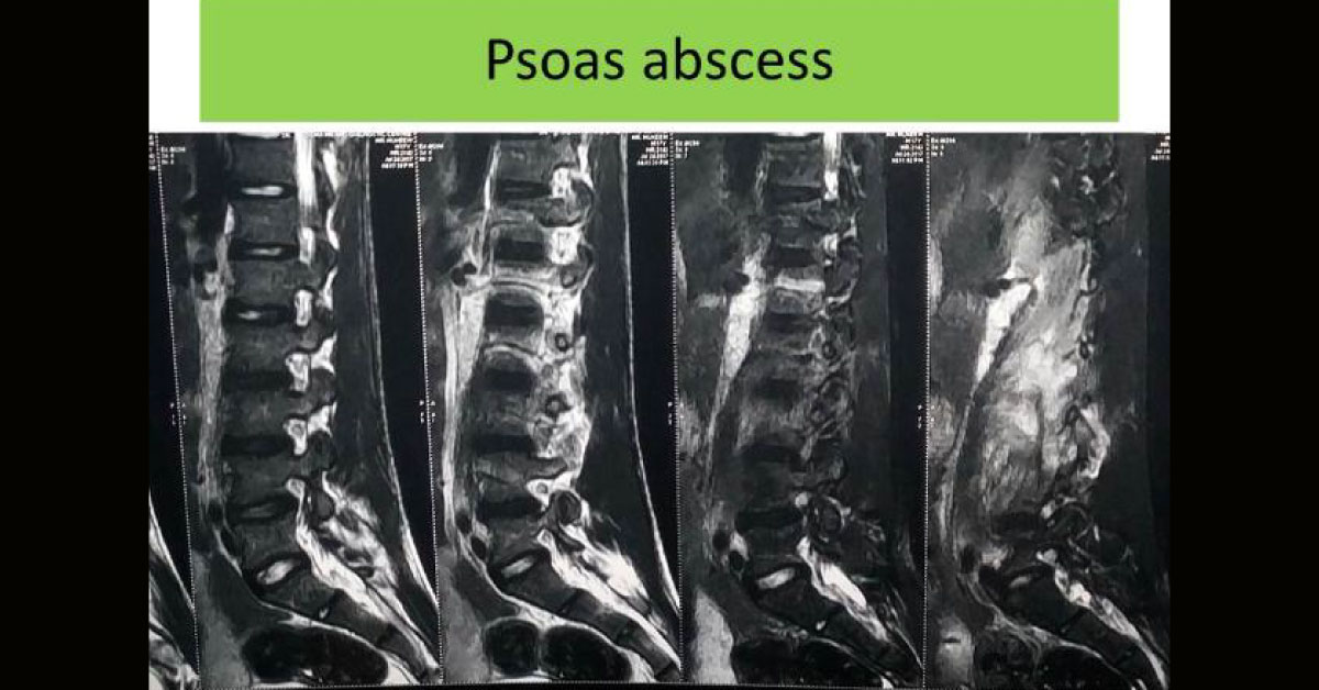 Case Of Psoas Abscess