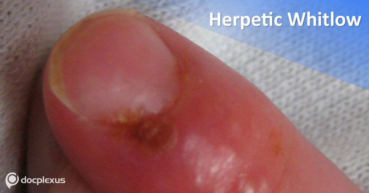 Herpetic Whitlow: Symptoms And Treatment