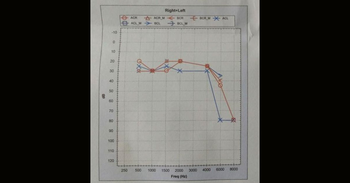 What Is The Interpretation Of This Audiogram?