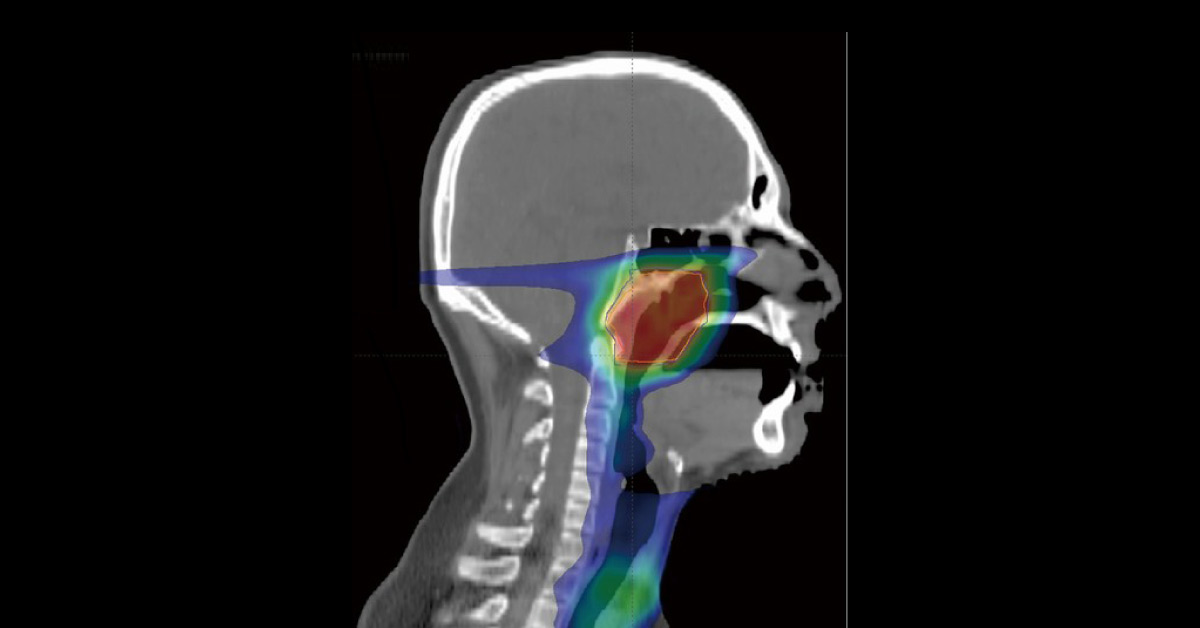New Blood Test For Nasopharyngeal Cancer