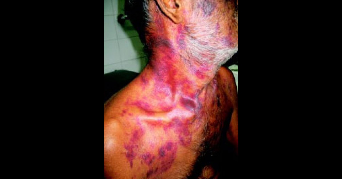 Diagnosis For Ecchymotic Patches