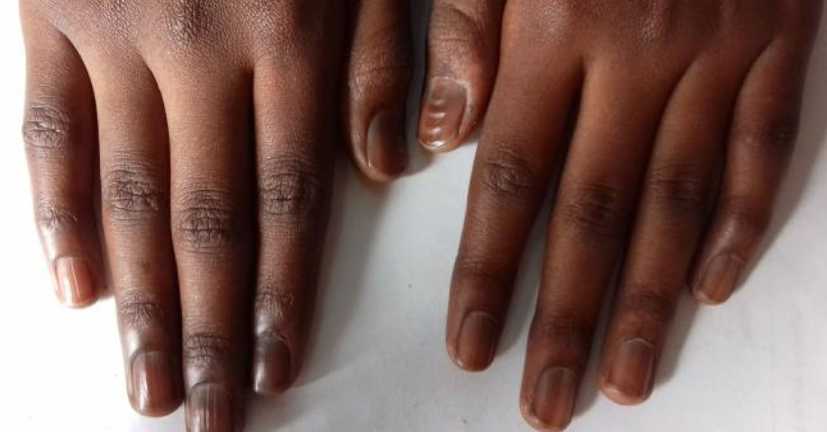 Boy With Pigmentation