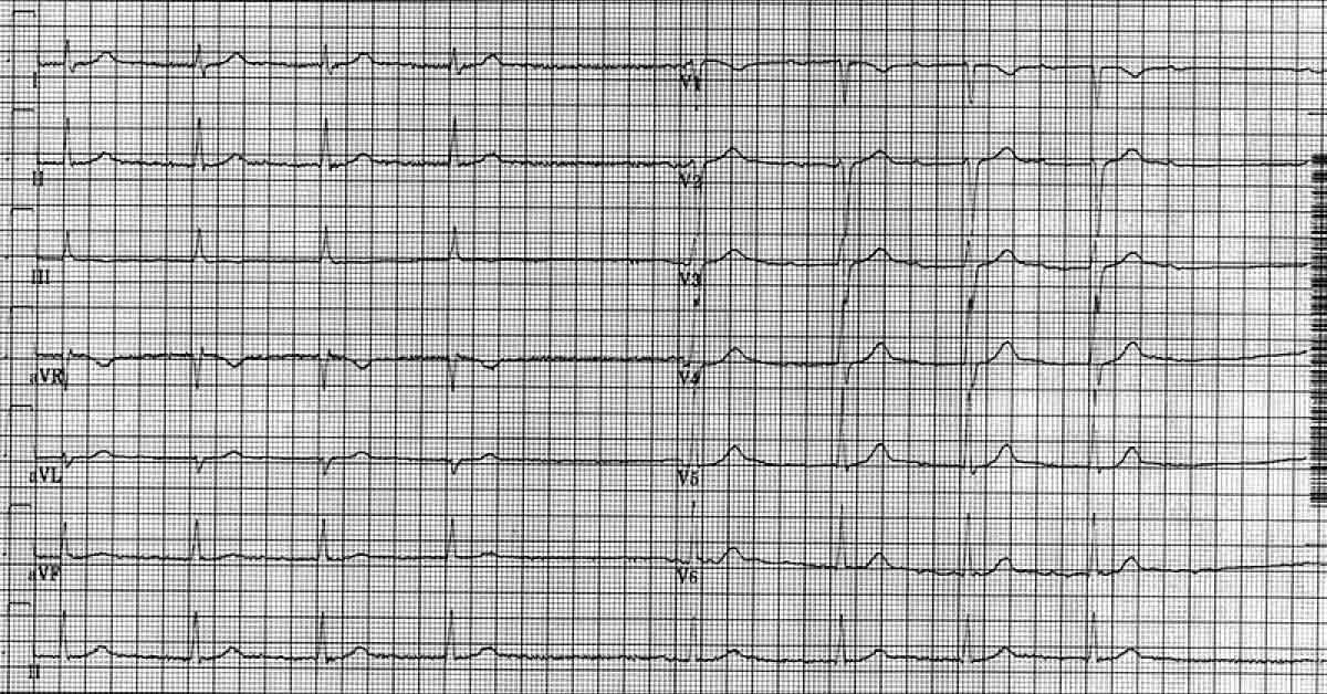 Identify This Cardiac Abnormality