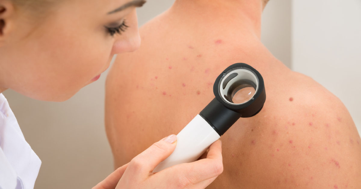 Clinical Management Of Primary Cutaneous Melanoma