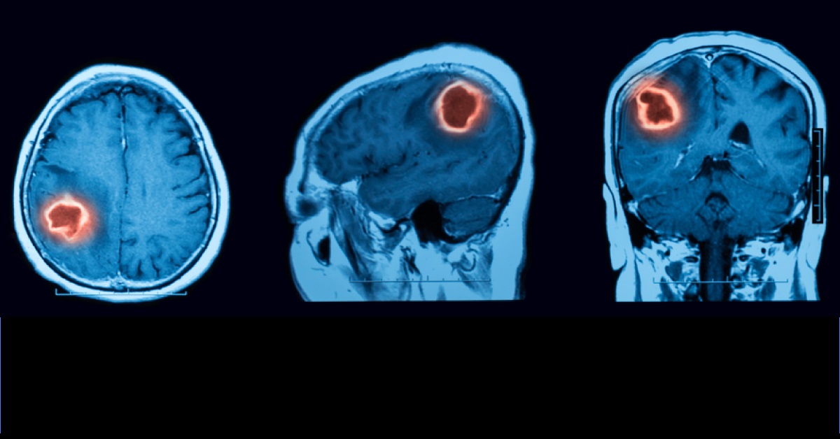 Permanent CSF Shunting After Intraventricular Hemorrhage