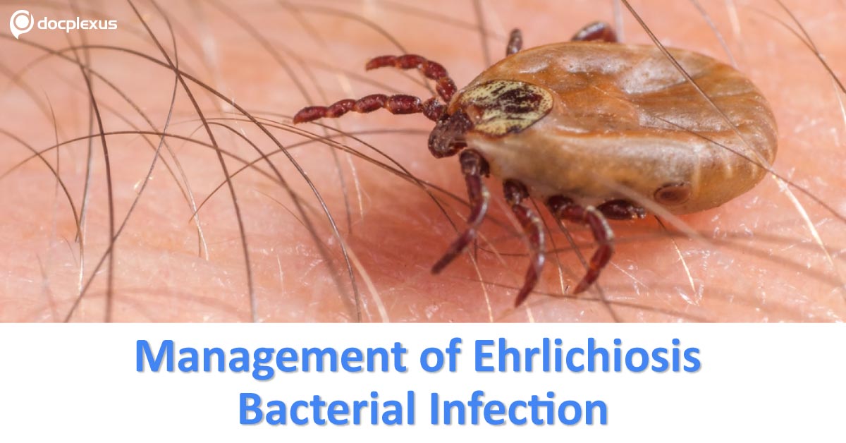 Ehrlichiosis, CDC Management Guidelines
