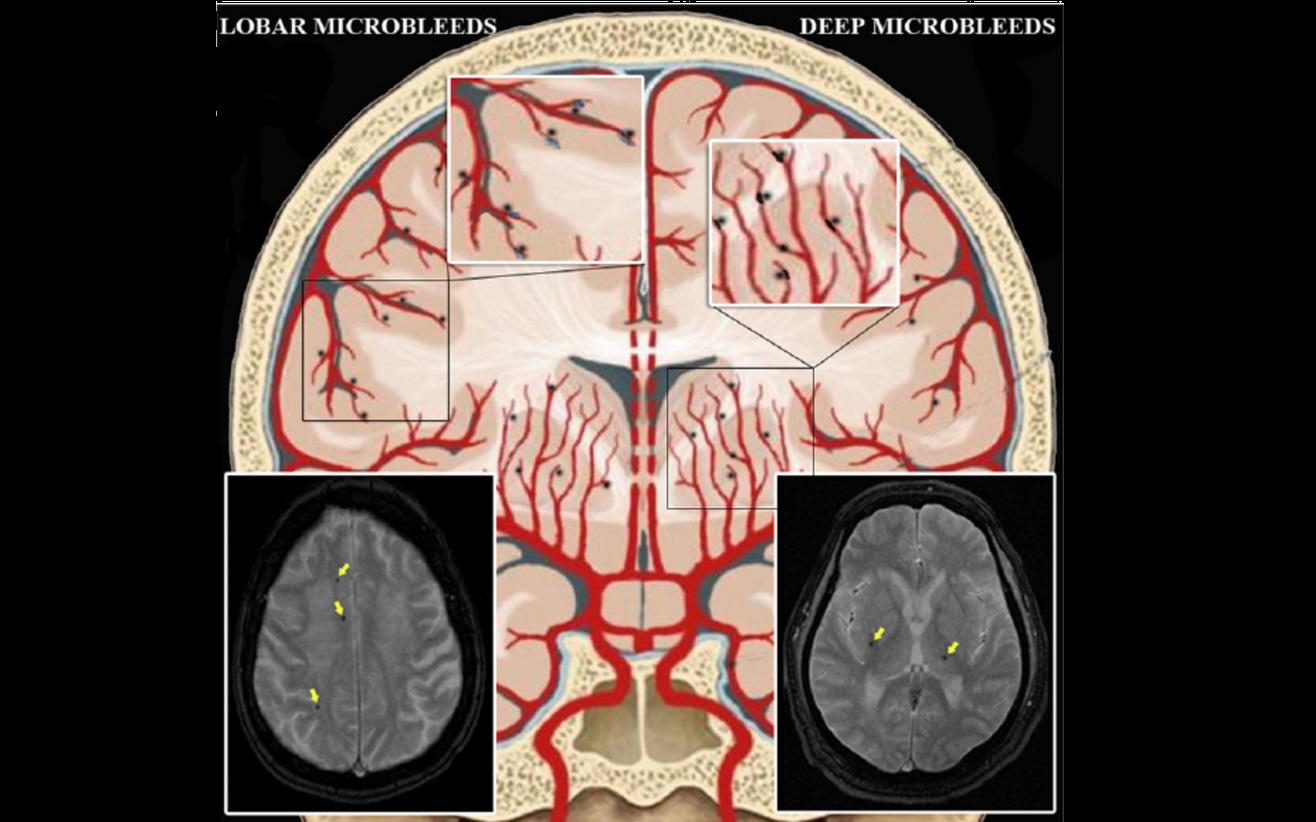 Dilemma Of Antithrombotics Use In Cerebral Microbleeds