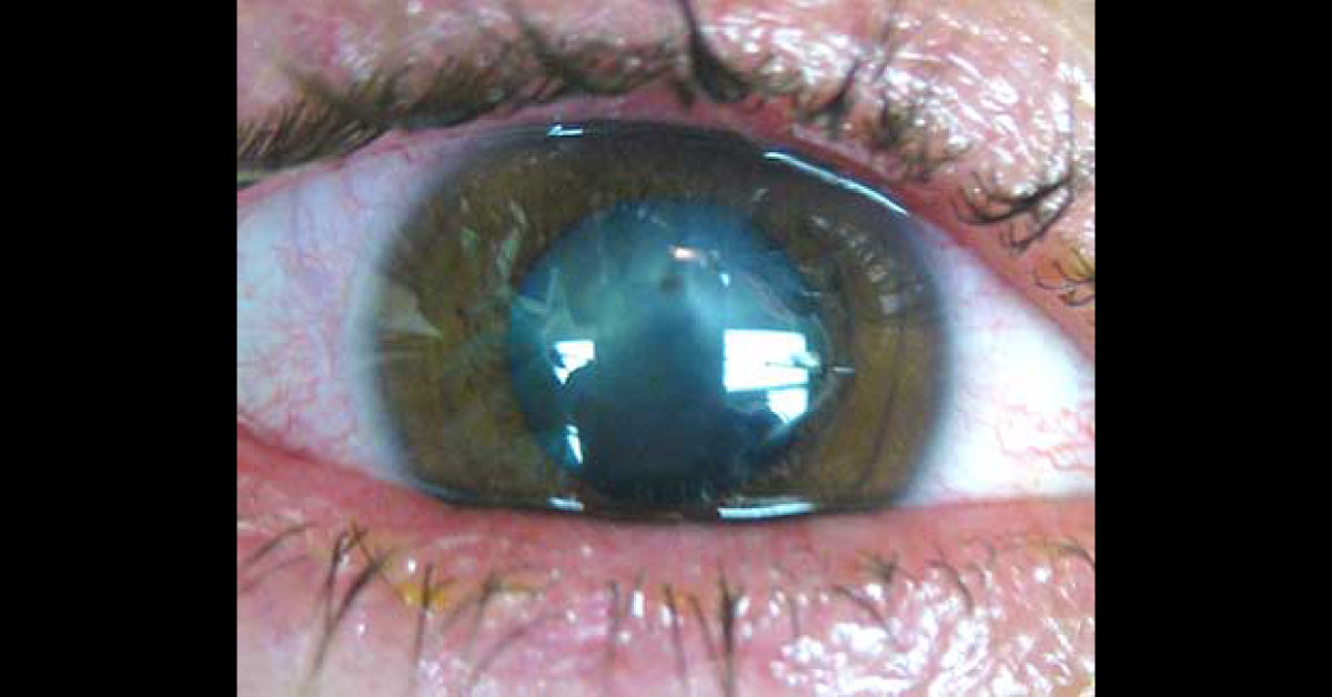 Case Of Worsened Tearing And Blurred Vision