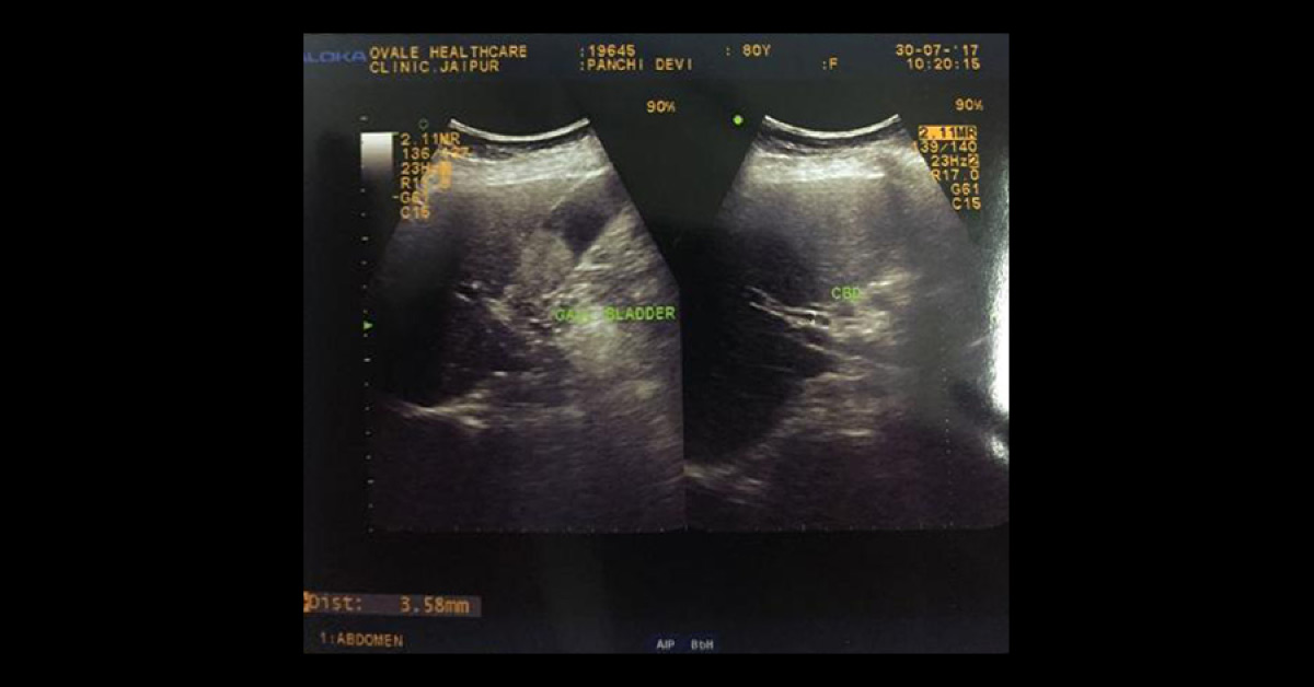 Is It CA Gall Bladder Or Thick Fat Ball In Gall Bladder
