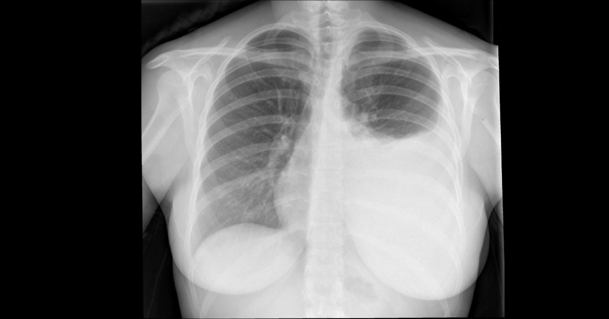 Diagnostic Tools For Pleural Effusion