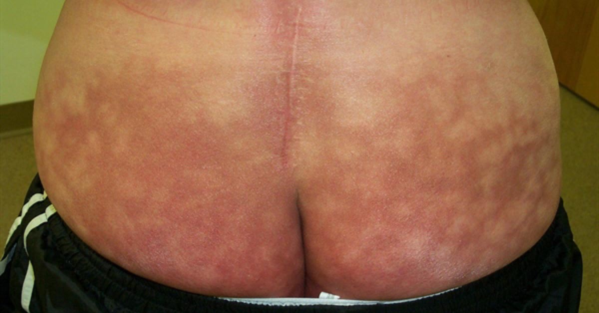 What Is This Discoloration On Buttocks