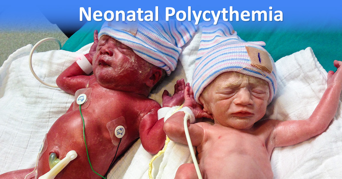 Neonatal Polycythemia, An Overview