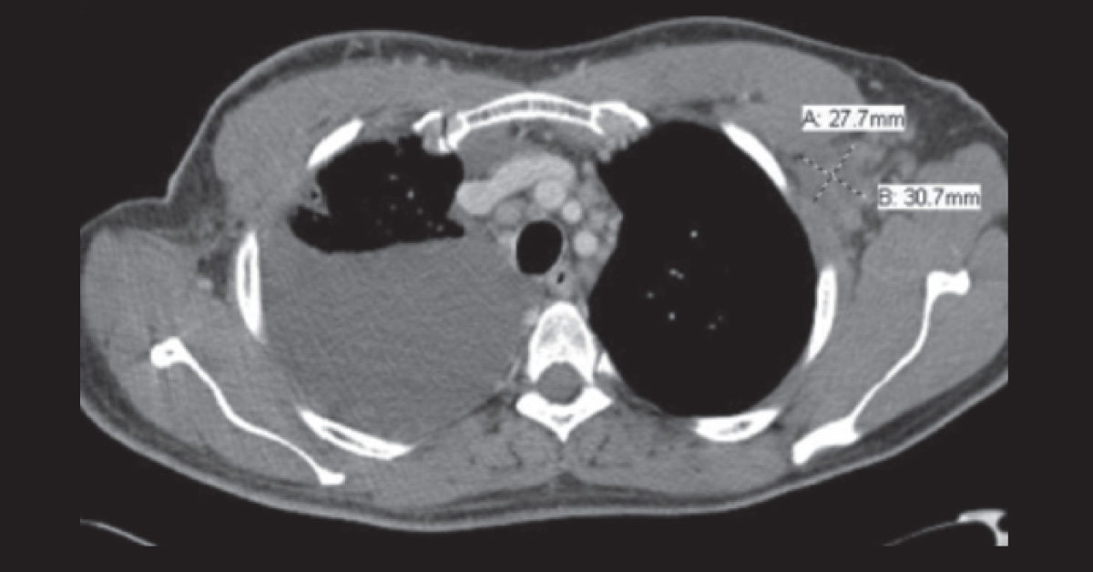 Breast Cancer in A 40-Year-Old Man