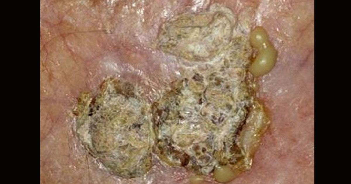Identify This Infectious Condition