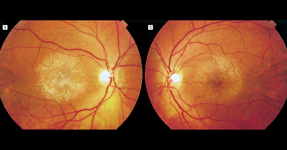 Drug Induced Corneal And Retinal Disorders