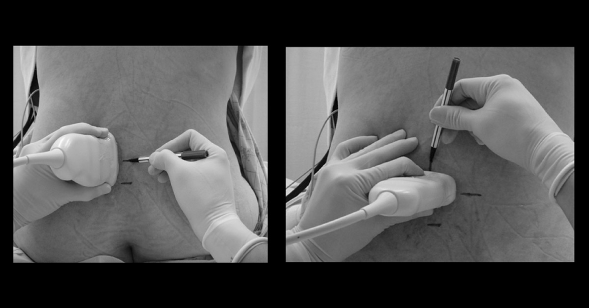 Reducing Risks Using Pre-procedure Neuraxial Ultrasound In Obstetric Anesthesia