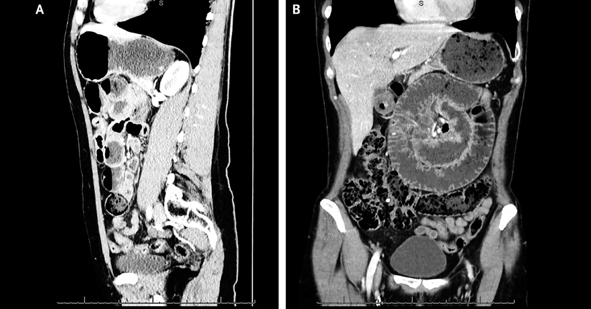 Identify The Condition From Attached CT Image