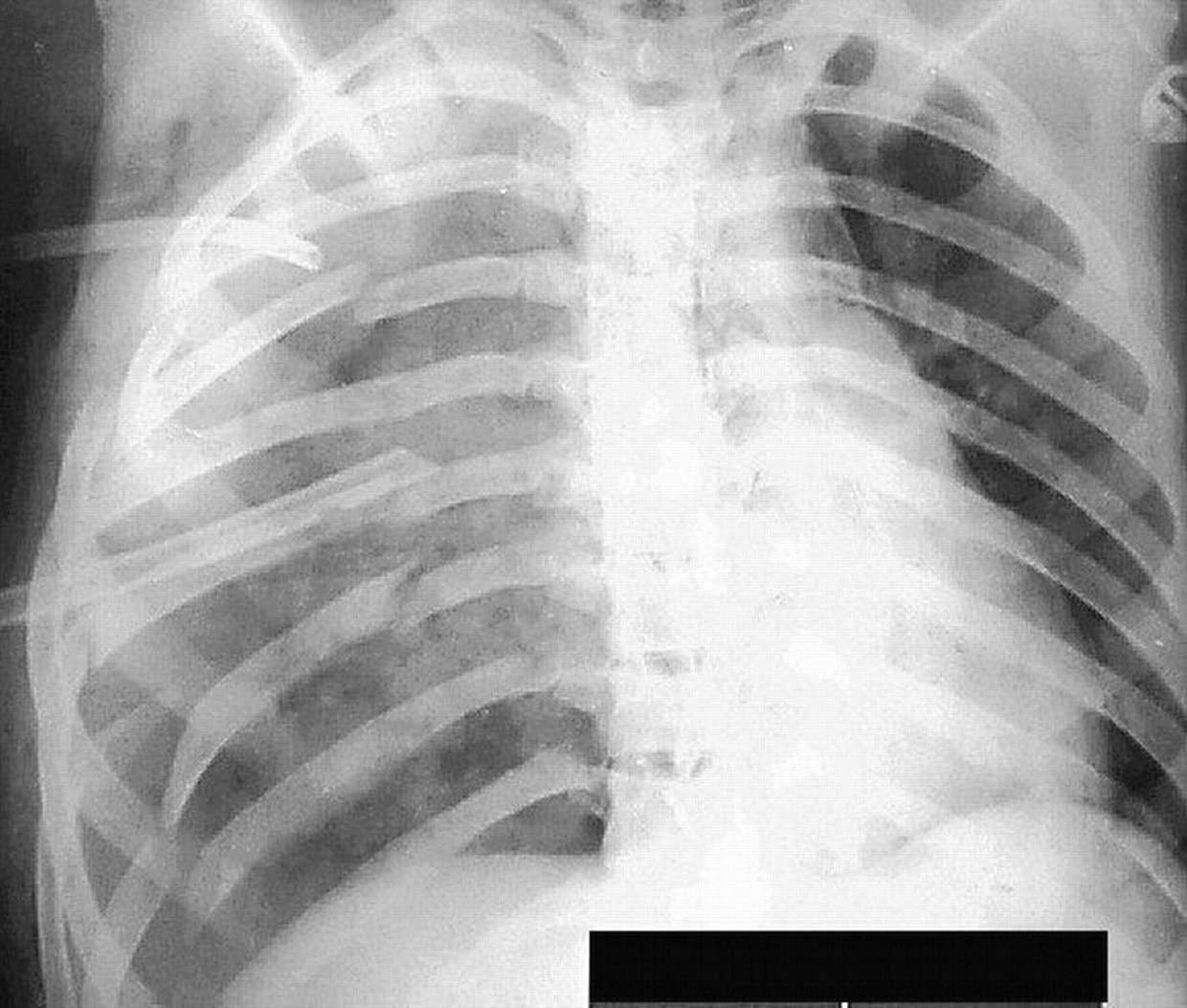 Flail Chest, An Insight