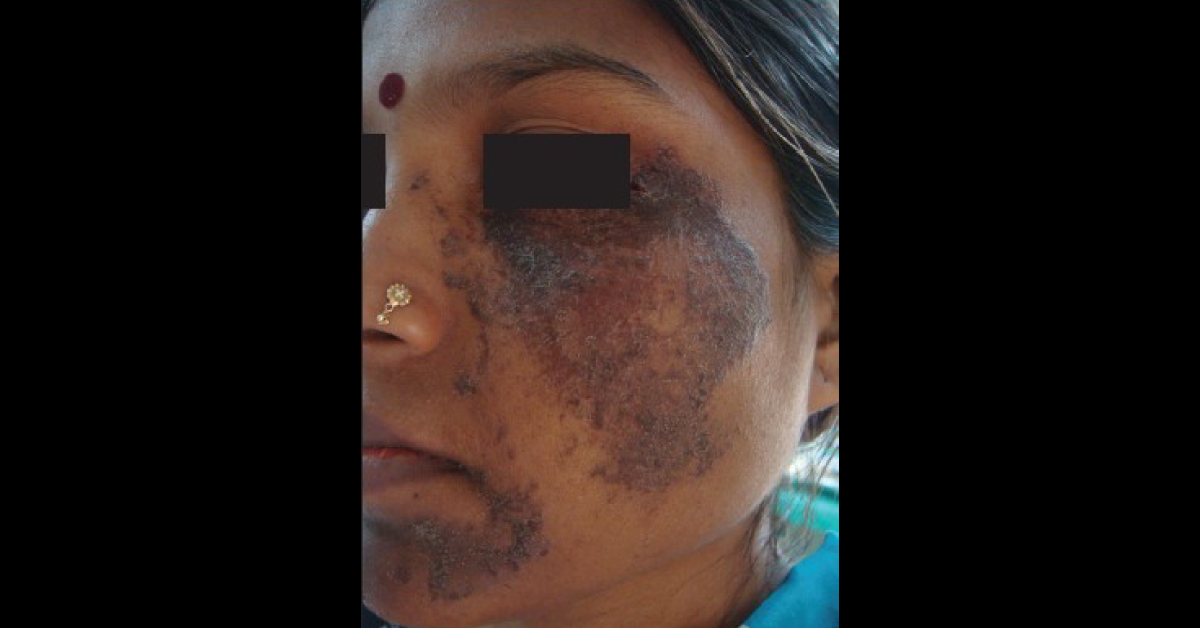 Identify The Dermatological Condition