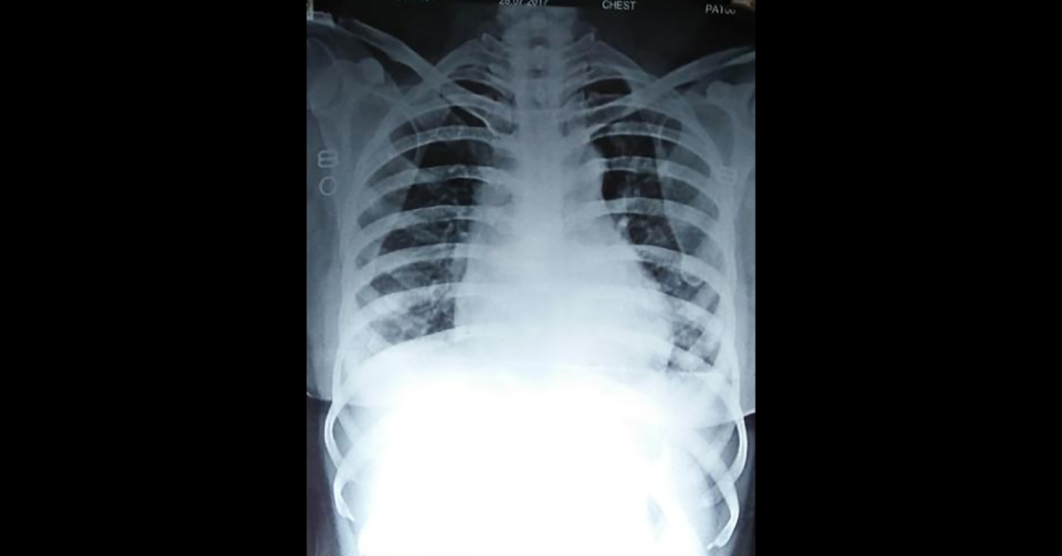 Is It Pericardial Pain Or Gastritis? 