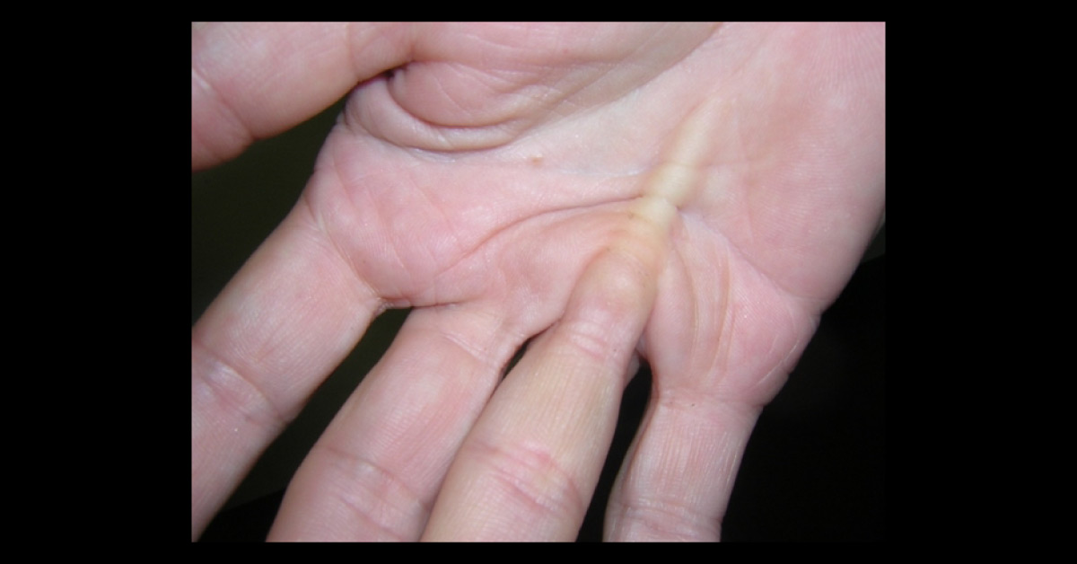 What Is This Knot In Palm?