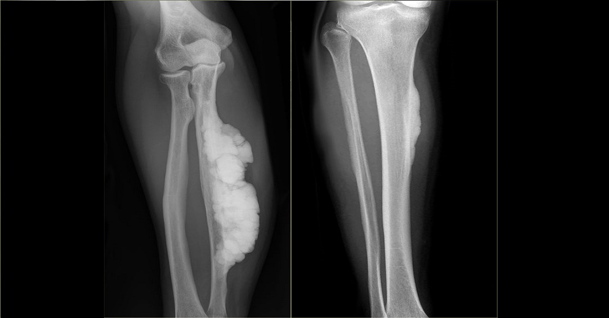 Paget’s disease, Approaches For Management