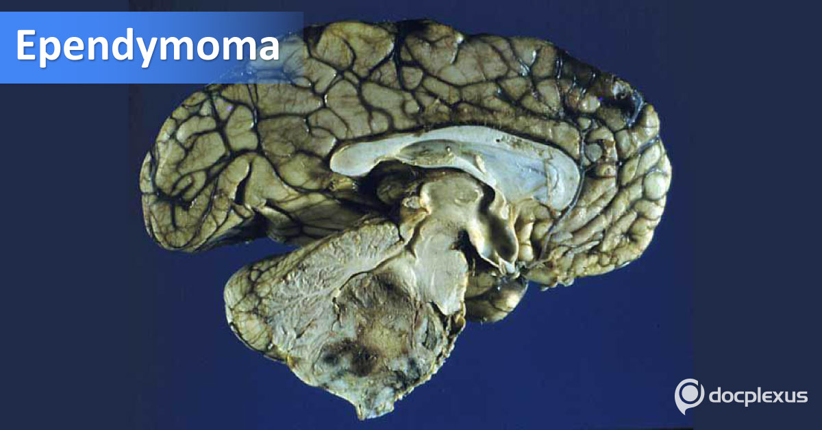 Ependymoma, Neurologic Manifestations And Treatment