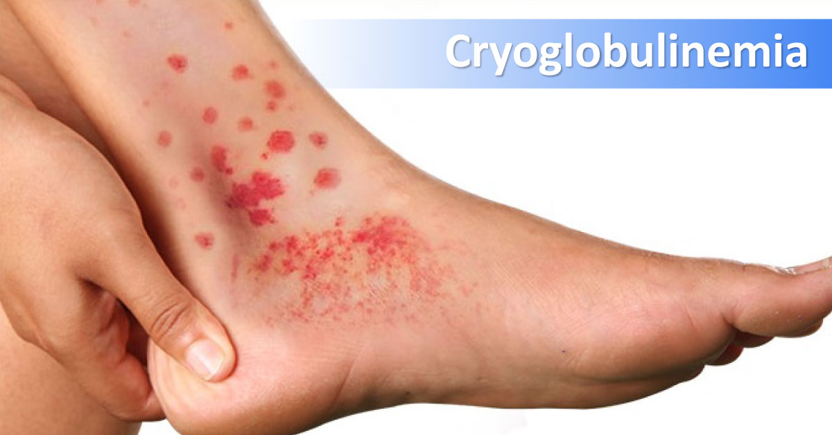 Management Of Cryoglobulinemia