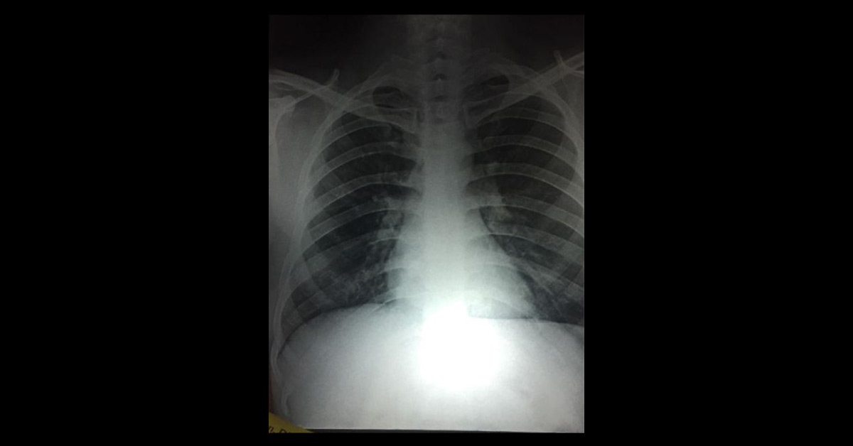 Can It Be Fungal Infection Or Sarcoidosis? 