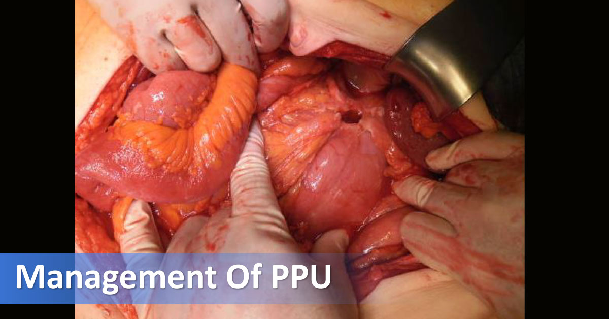 Perforated Peptic Ulcer, Management And Recent Advancements