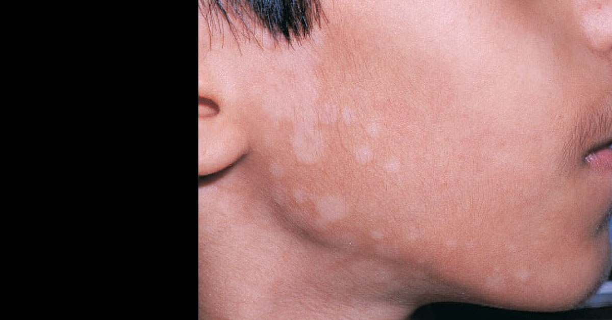 Spot This Derma Condition