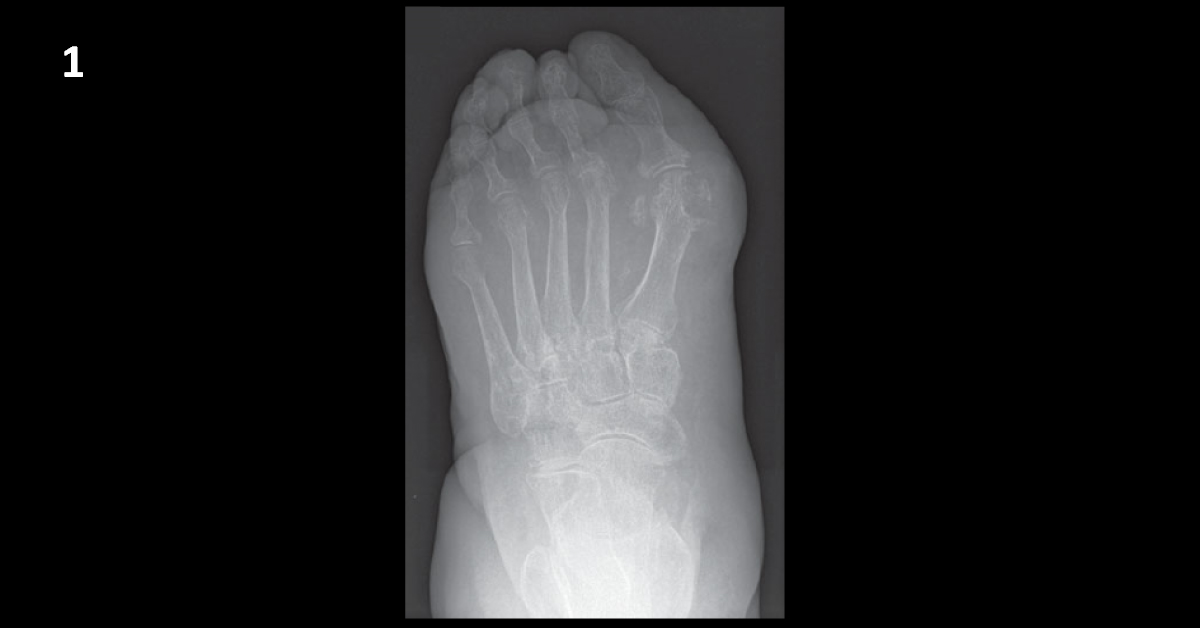 The Case Of Painful Big Toe