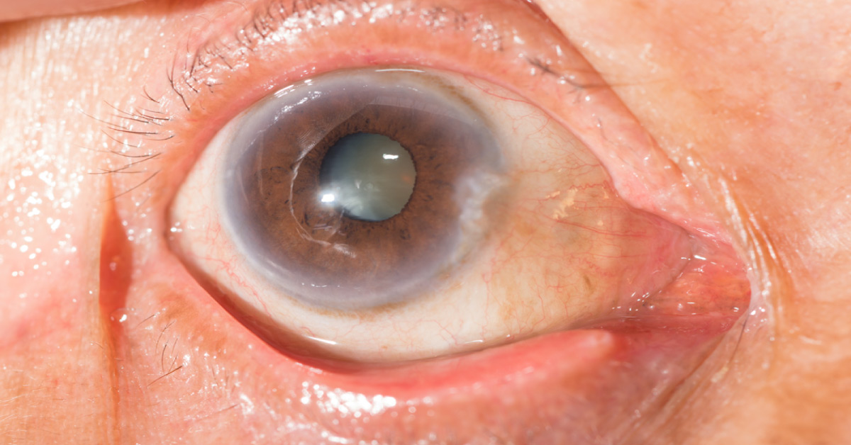 The Pathogenesis Of Diabetic Cataract