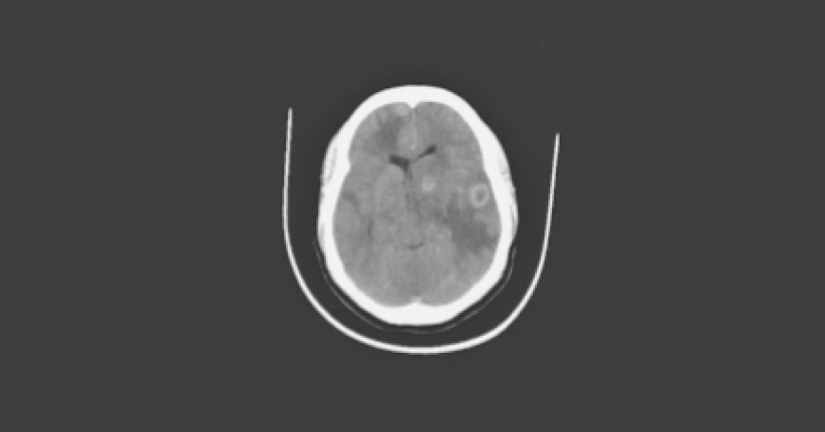 Diagnose The Cause For Headache And Confusion