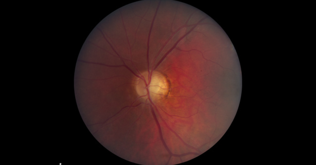 Solve This Ophthalmology Case