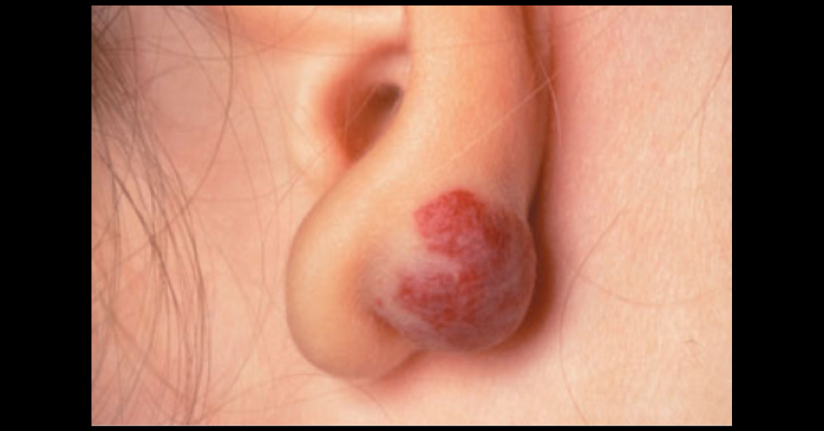 Identify This Red Ear Lesion