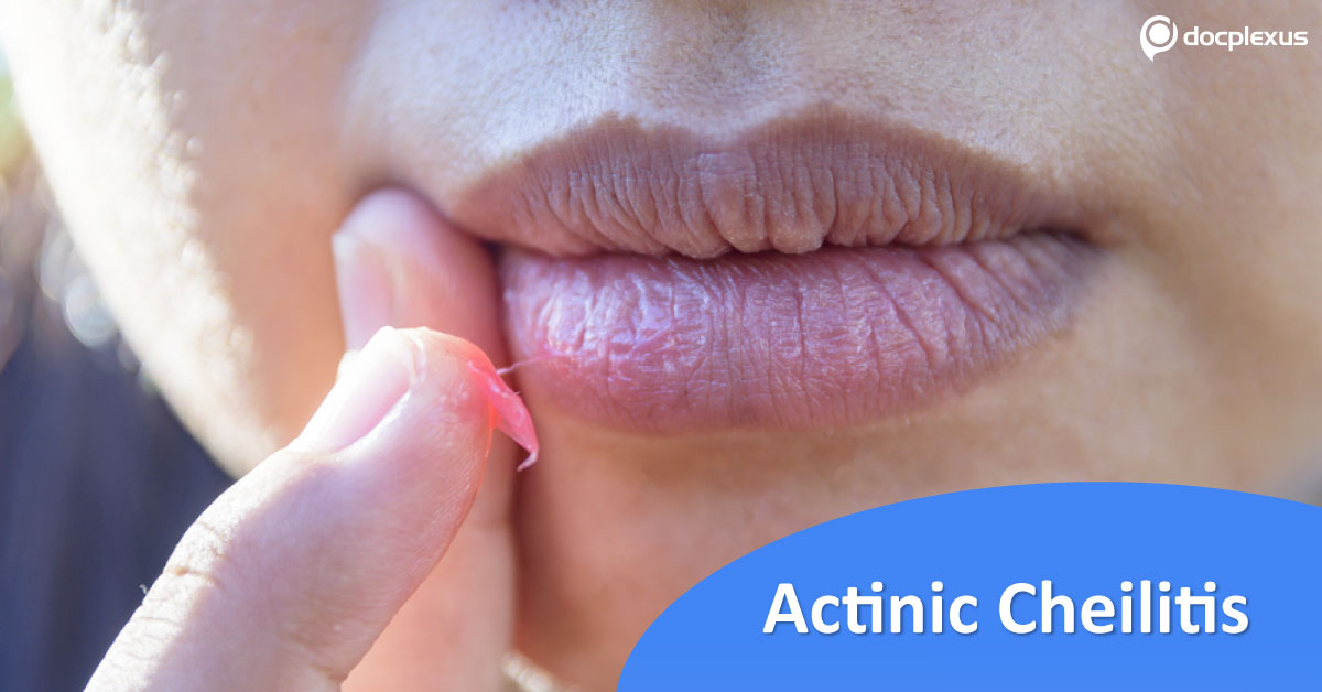 Overview Of Precancerous Condition, Actinic Cheilitis